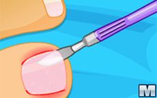 Ingrown Toenail Surgery